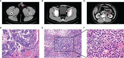 Single-Cell RNA Sequencing of Metastatic Testicular Seminoma Reveals the Cellular and Molecular Characteristics of Metastatic Cell Lineage